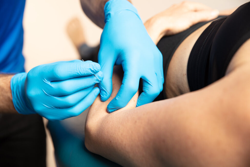 Behandeling met dry needling methode